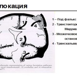 Интенсивная терапия при сотрясении головного мозга ушибе