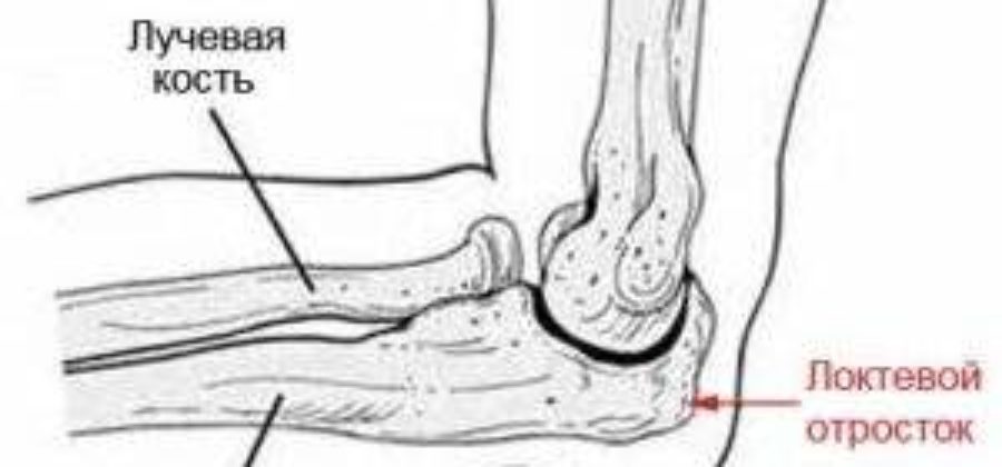 Перелом локтевого отростка локтевой кости со смещением