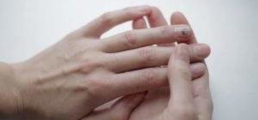 Ушиб пальца кисти с повреждением ногтевой пластинки