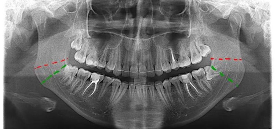 Минипластины для остеосинтеза переломов челюстей изготавливаются из