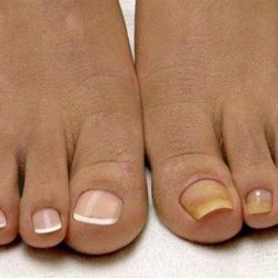 Как отличить грибок ногтя от ушиба ногтя на ноге?