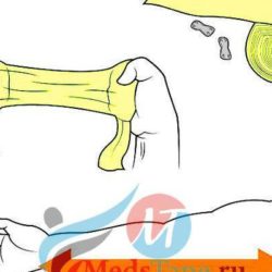 Как наматывать эластичный бинт на руку при ушибе?