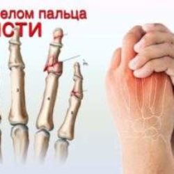 Первая медицинская помощь при переломе пальца руки
