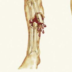 Открытые переломы костей и особенности их лечения