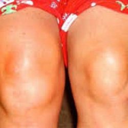Как снять отек с коленного сустава после травмы боковых связок?
