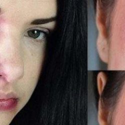 Как убрать синяки под глазами после ушиба?