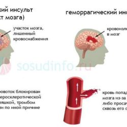 Лечение отека мозга при кровоизлиянии в мозг