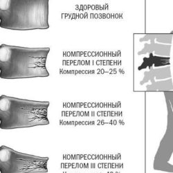 Почему после перелома позвоночника не могут ходить?