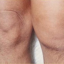 Боль и отек в коленном суставе без травмы