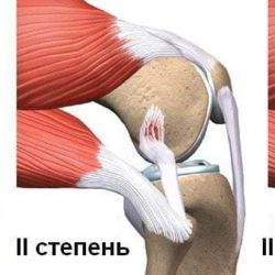 Растяжение связок коленного сустава лечение чем снять отек