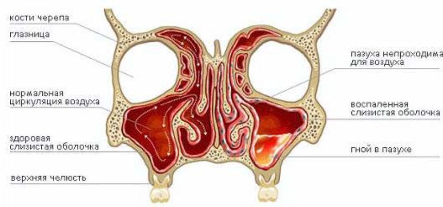 Почему отек переходит из одной ноздри в другую?