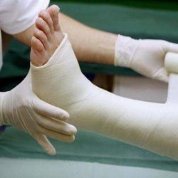 Что делать при переломе ноги у человека?