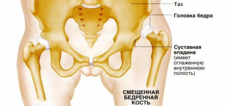 Вывих бедра у детей симптомы и лечение