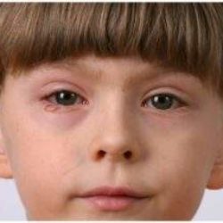 Отек вокруг глаз у ребенка левая сторона сильнее отекает причины