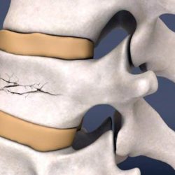 Осложнения после компрессионного перелома позвоночника поясничного отдела