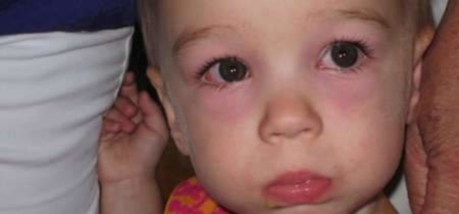 Отек верхнего века одного глаза у ребенка причины и лечение