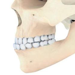 Описание рентгеновского снимка при переломе нижней челюсти