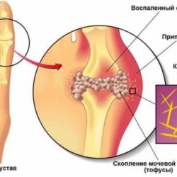 Подагра чем снять боль и отек в домашних условиях