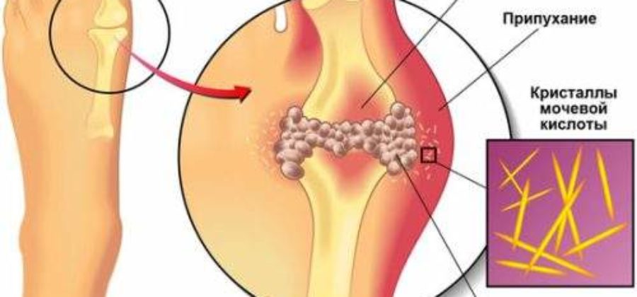 Подагра чем снять боль и отек в домашних условиях
