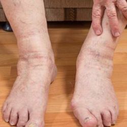 Причина отека ног в щиколотке и ступне у мужчины