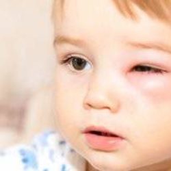 Аллергический отек у ребенка как снять отек