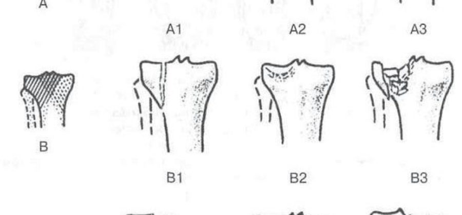 Сроки иммобилизации при изолированном переломе большеберцовой кости