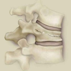 Как долго болит спина после перелома позвоночника?