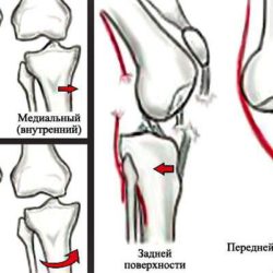 Повреждение подколенной артерии при переднем вывихе в коленном суставе