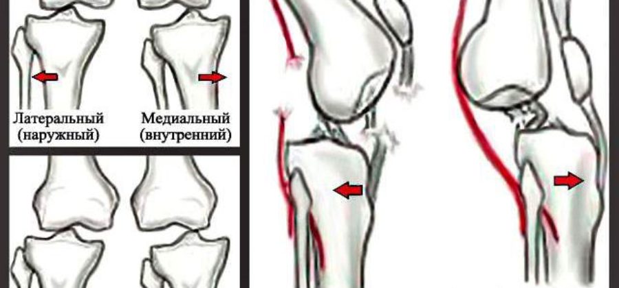 Повреждение подколенной артерии при переднем вывихе в коленном суставе