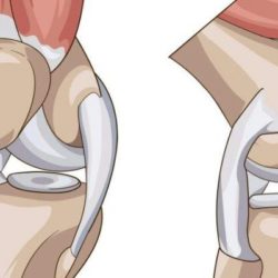 Ушиб мениска коленного сустава что это такое