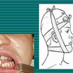 Лечение перелома нижней челюсти в нижнем новгороде