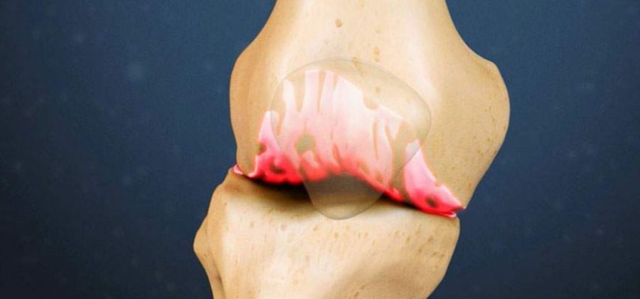 Как лечить ушиб коленного сустава и жидкость в колене?