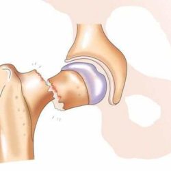 Как уберечь себя от перелома шейки бедра?