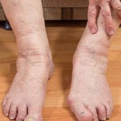 Отек ступней и щиколоток у мужчин при атеросклерозе