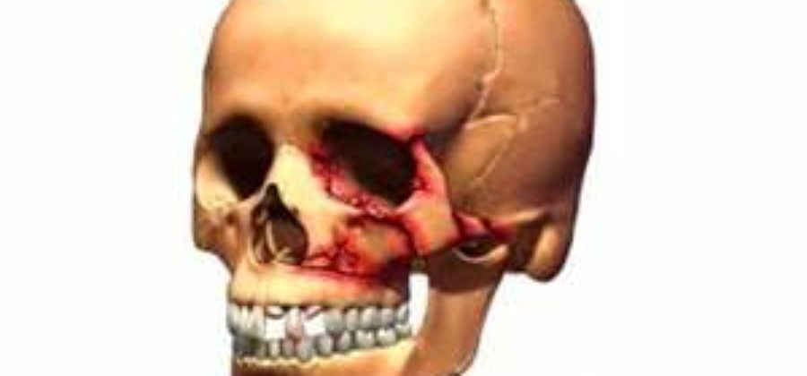 Синоним перелома верхней челюсти по фор 3