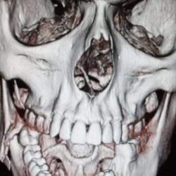 Классификация неогнестрельных переломов нижней челюсти по энтину