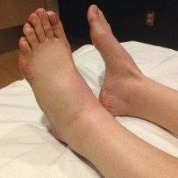 Боль в ноге отек левой ноги с чем связан