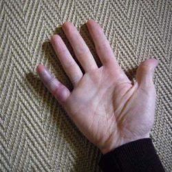Чем лечить палец при сильном ушибе с гематомой