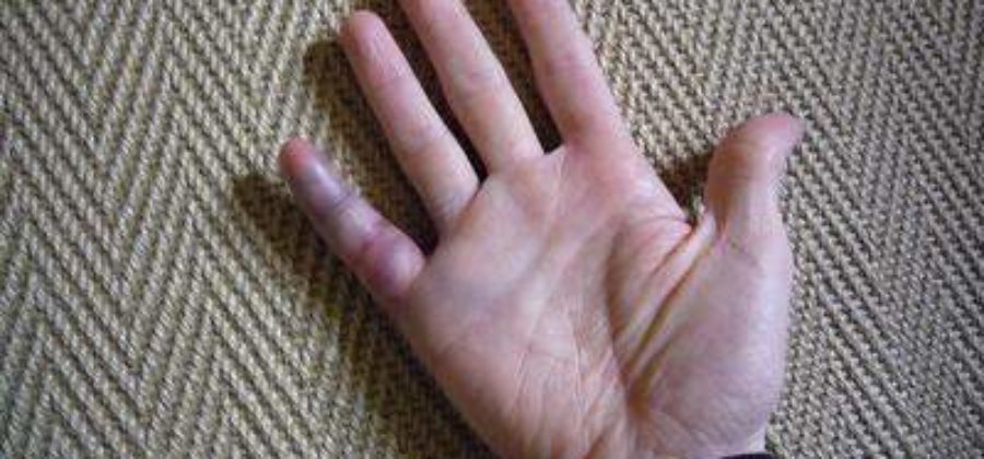 Чем лечить палец при сильном ушибе с гематомой