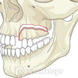 Перелом нижней челюсти во время удаления зуба