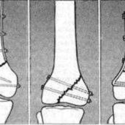 Перелом межмыщелкового возвышения большеберцовой кости у детей