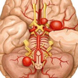 Отек головного мозга после аневризмы и его последствия