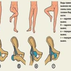 Привычный вывих тазобедренного сустава у взрослых