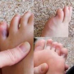 Вывих пальца на ноге симптомы и лечение