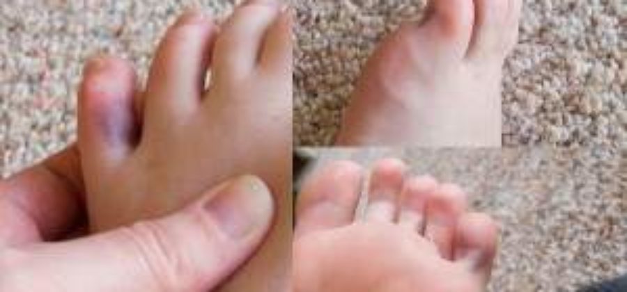 Вывих пальца на ноге симптомы и лечение