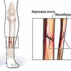 После перелома малой берцовой кости отекает ступня