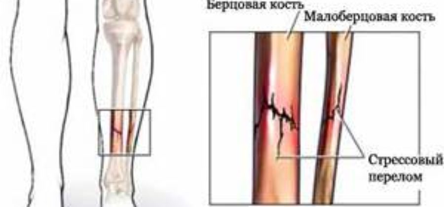 После перелома малой берцовой кости отекает ступня