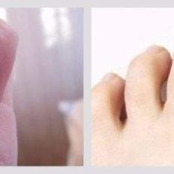 Что делать если ушиб палец на руке и ноготь посинел?