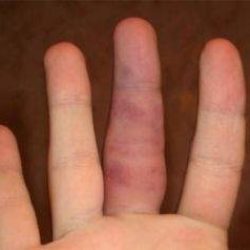 Болит палец на руке при сгибании после ушиба