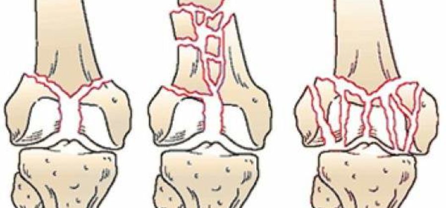 Около и внутрисуставные переломы костей нижних конечностей